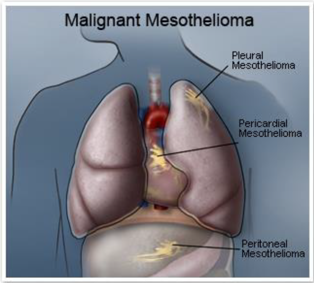 Fact Sheet on Mesothelioma NCR 2017